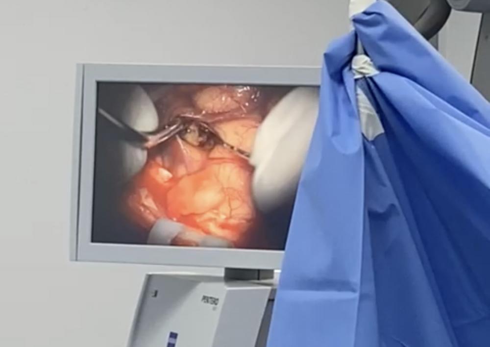Hospital realiza neurocirurgia complexa com paciente acordada para retirada de tumor cerebral