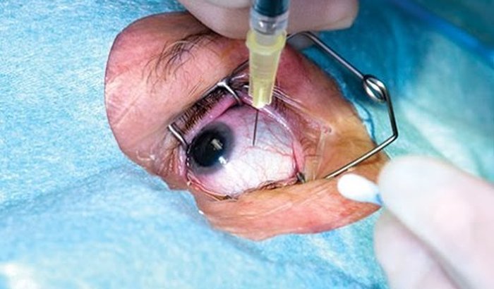 Cirurgia de retina poderá entrar na fila de “urgência” do sistema de regulação